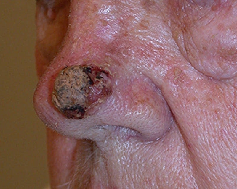 Complex Facial Reconstruction Cancer Trauma Before & After