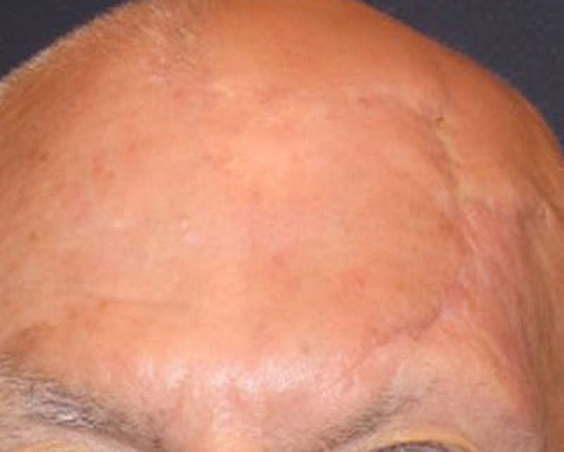 Complex Facial Reconstruction Cancer Trauma Before & After