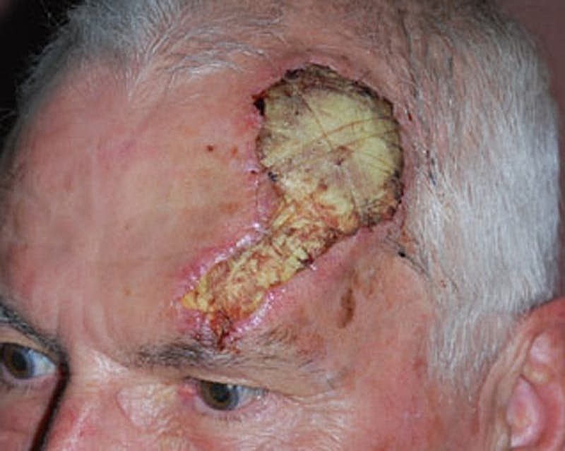 Complex Facial Reconstruction Cancer Trauma Before & After