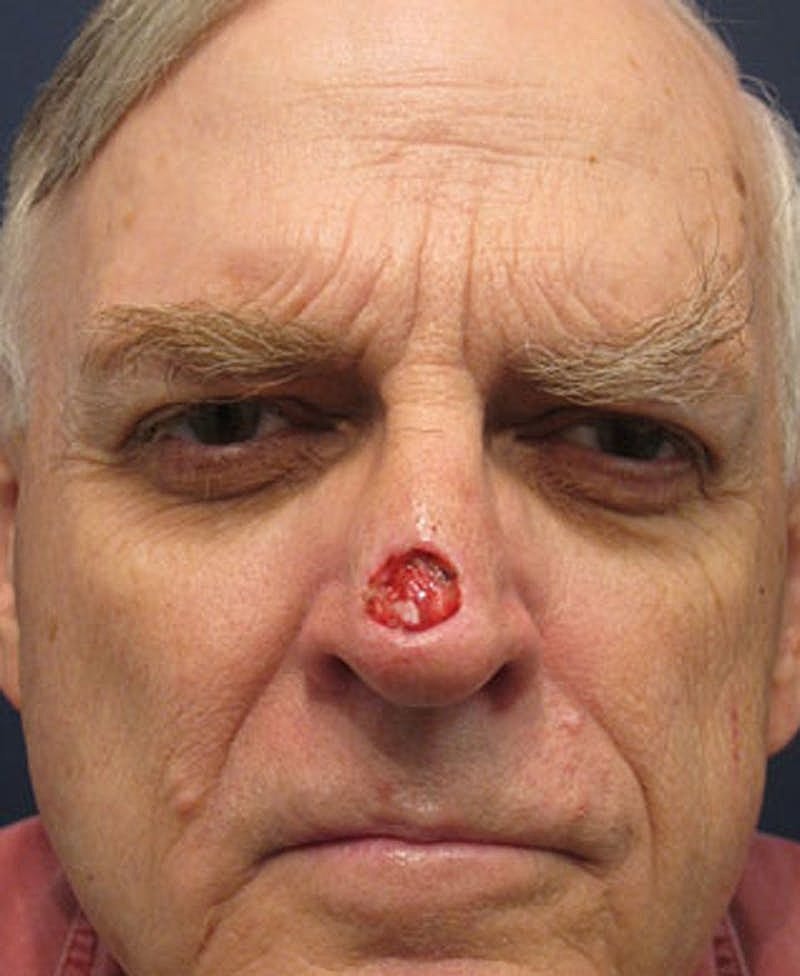 Complex Facial Reconstruction Cancer Trauma Before & After