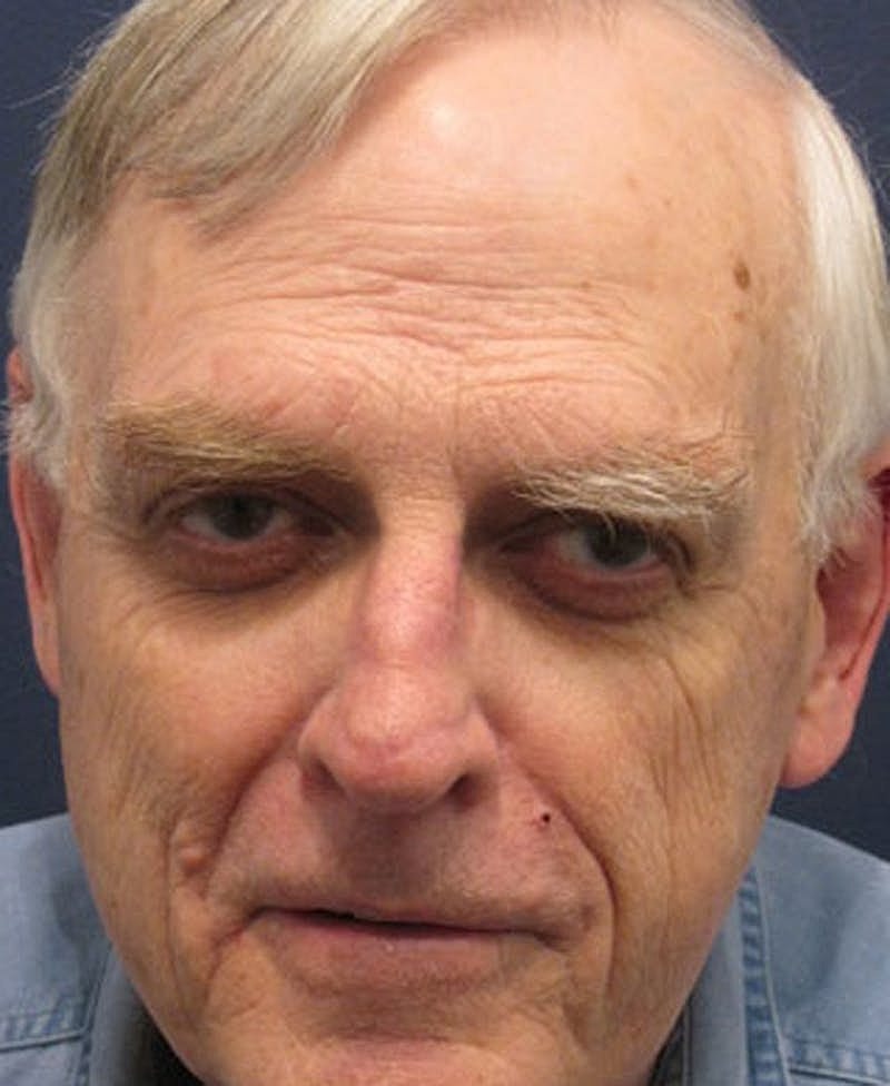 Complex Facial Reconstruction Cancer Trauma Before & After