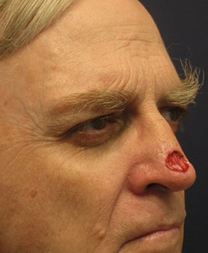 Complex Facial Reconstruction Cancer Trauma Before & After