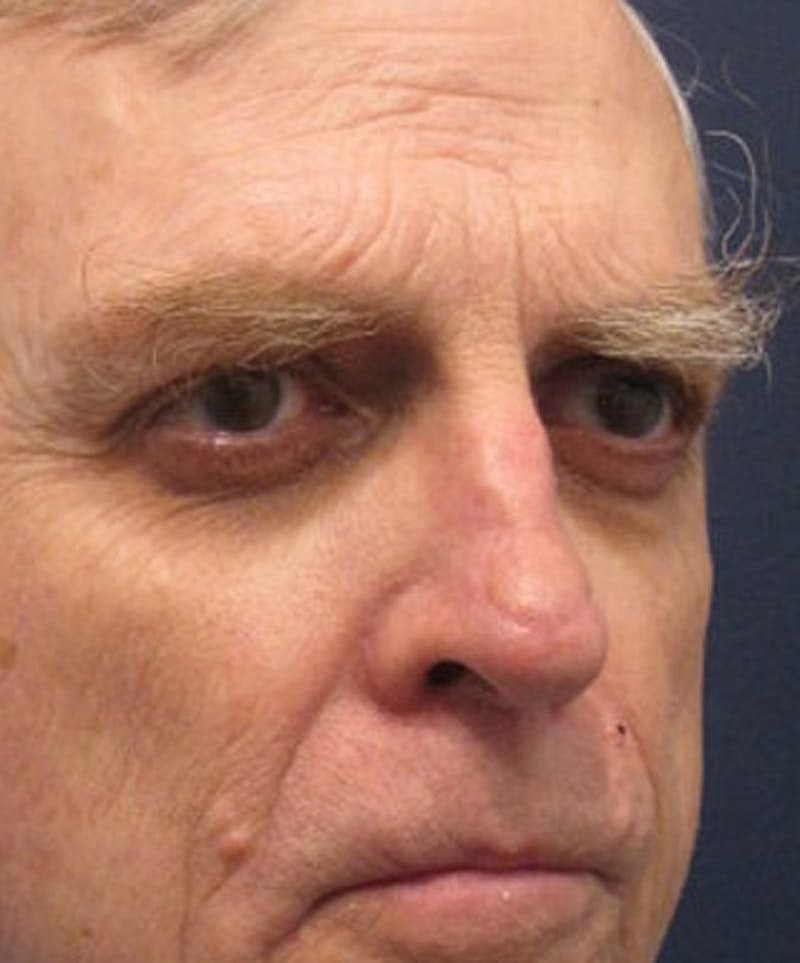 Complex Facial Reconstruction Cancer Trauma Before & After