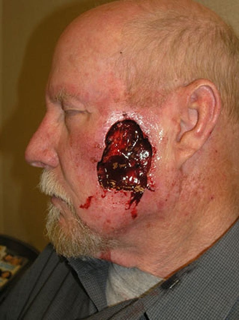 Complex Facial Reconstruction Cancer Trauma Before & After