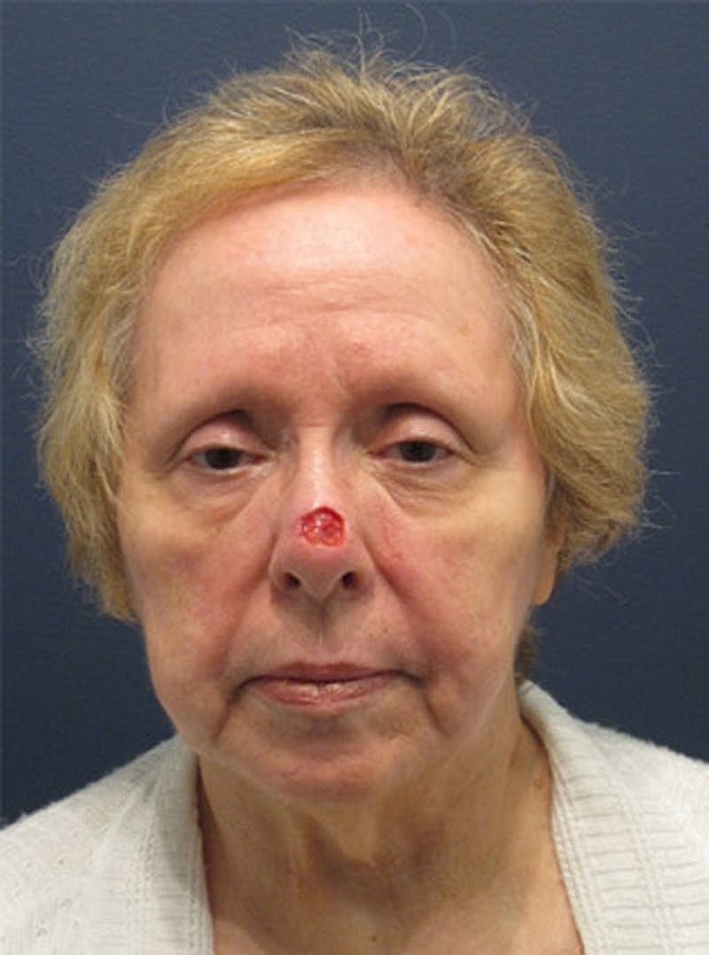 Complex Facial Reconstruction Cancer Trauma Before & After