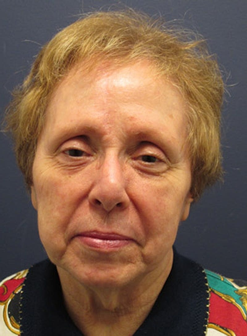 Complex Facial Reconstruction Cancer Trauma Before & After