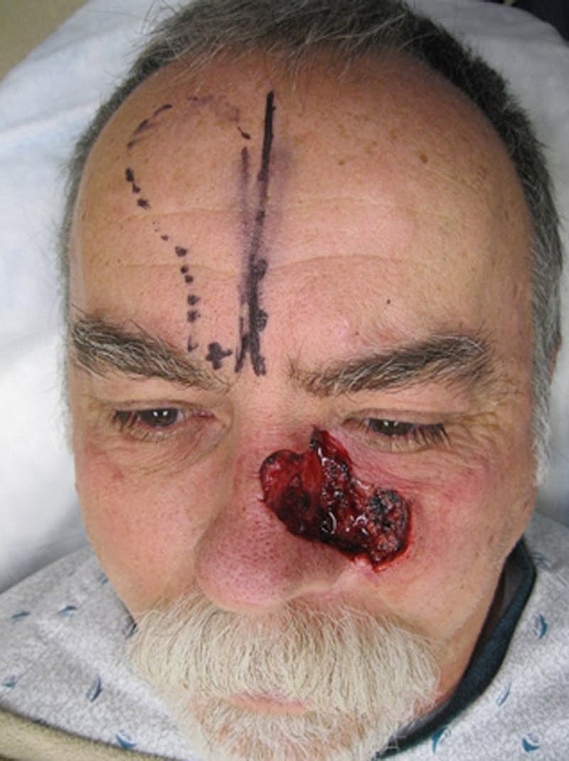 Complex Facial Reconstruction Cancer Trauma Before & After