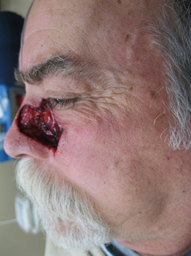 Complex Facial Reconstruction Cancer Trauma Before & After