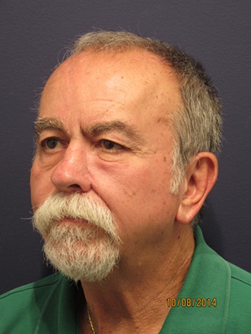 Complex Facial Reconstruction Cancer Trauma Before & After