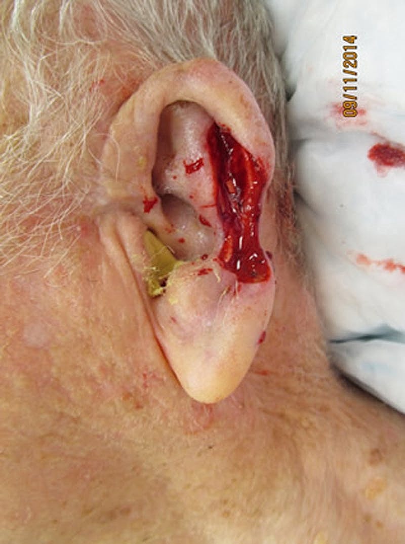 Complex Facial Reconstruction Cancer Trauma Before & After