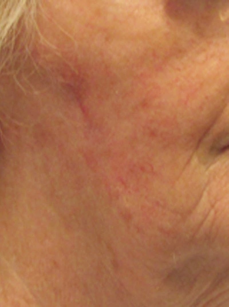 Complex Facial Reconstruction Cancer Trauma Before & After