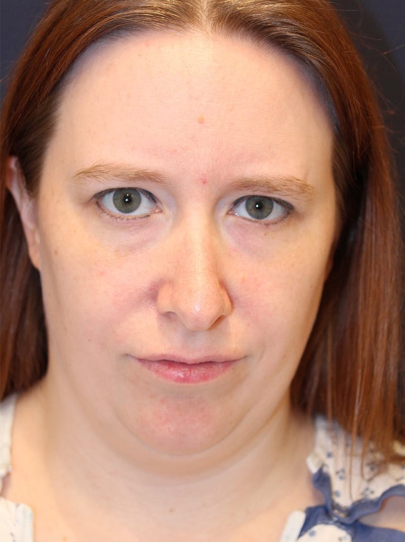 Neck Liposuction Before & After