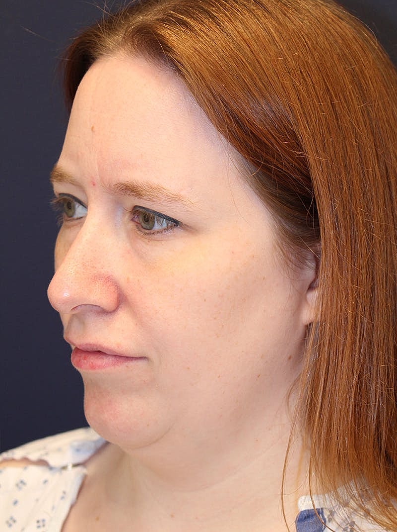 Neck Liposuction Before & After