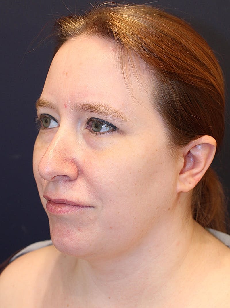 Neck Liposuction Before & After