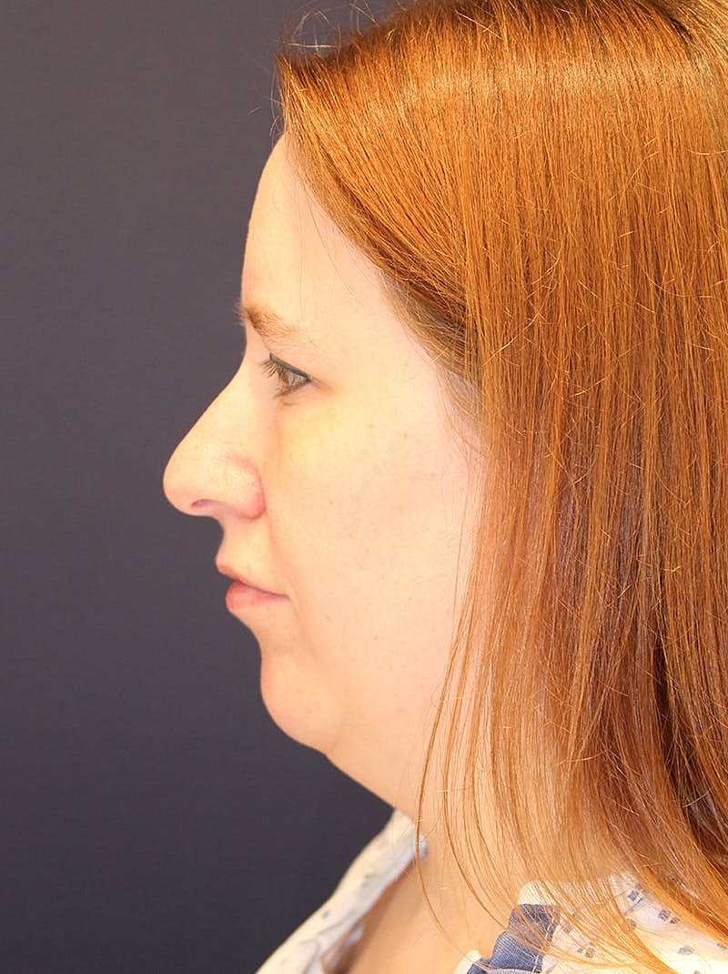 Neck Liposuction Before & After