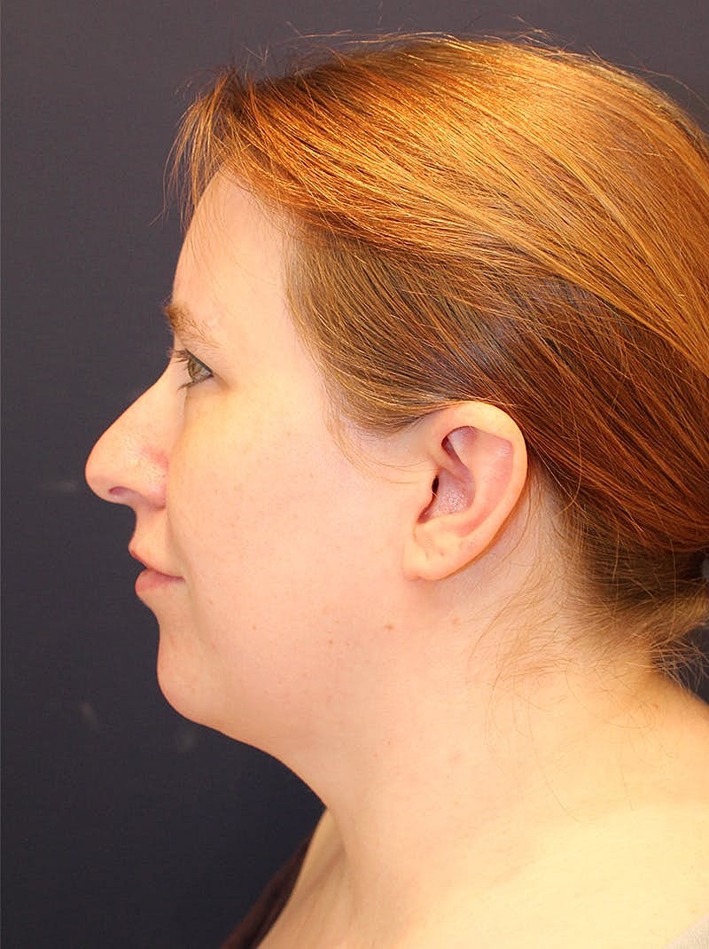 Neck Liposuction Before & After
