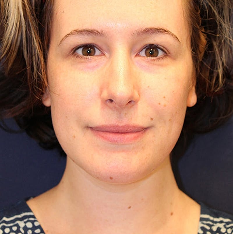 Neck Liposuction Before & After