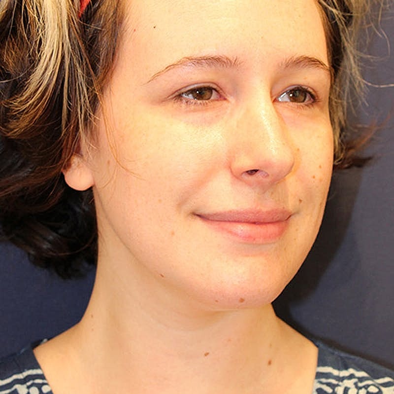 Neck Liposuction Before & After