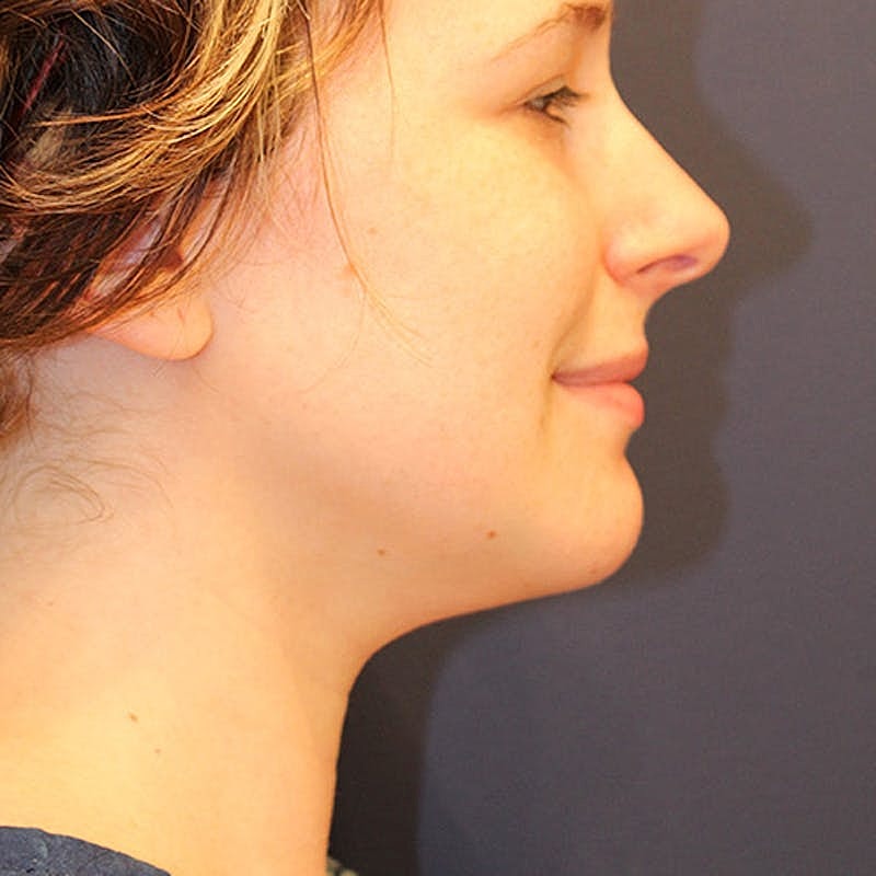 Neck Liposuction Before & After