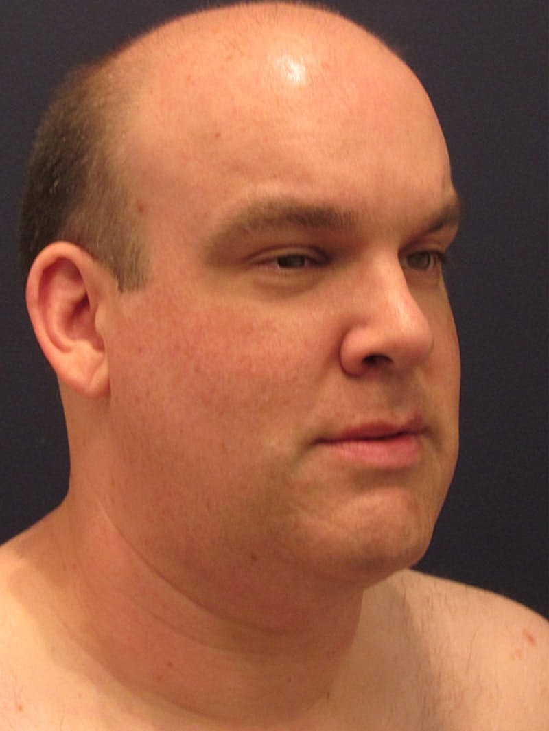 Neck Liposuction Before & After