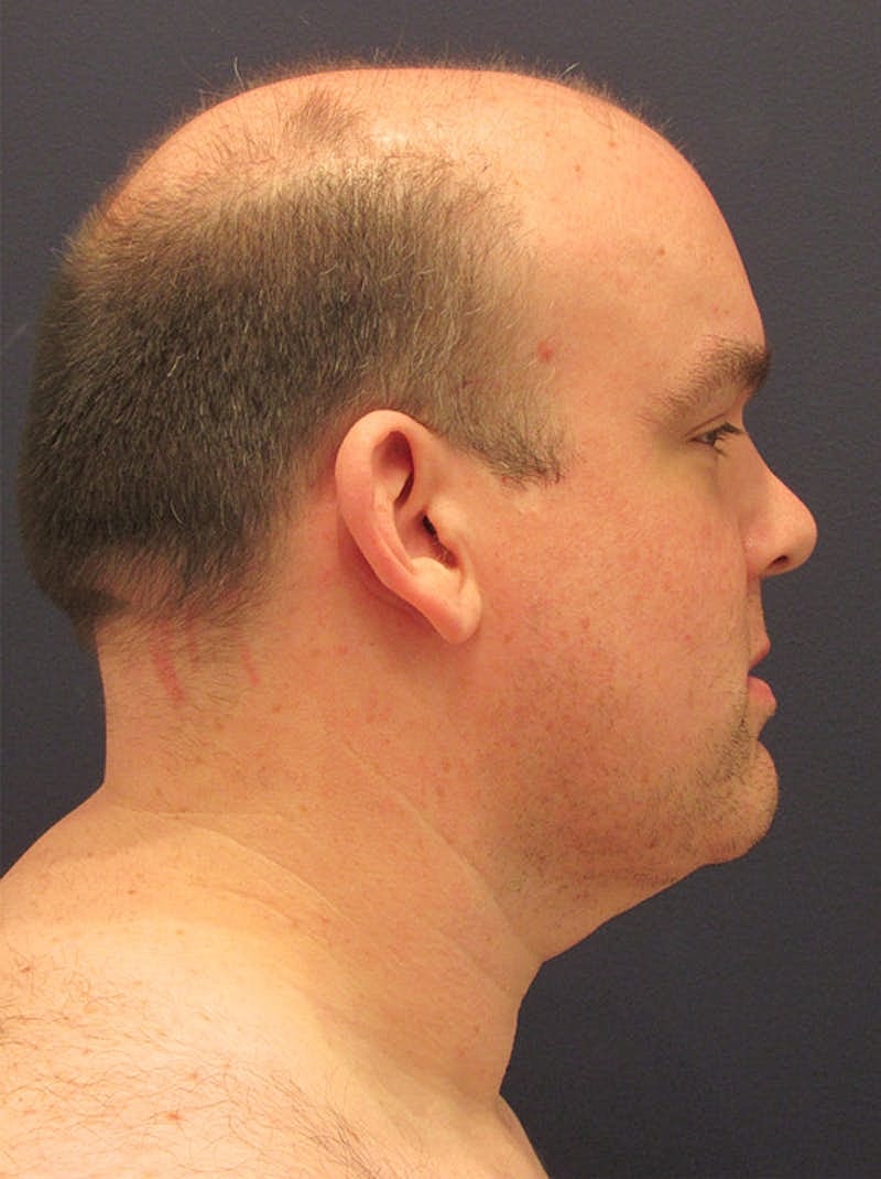 Neck Liposuction Before & After