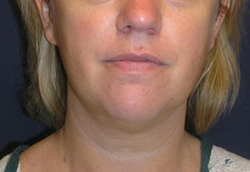 Neck Liposuction Before & After