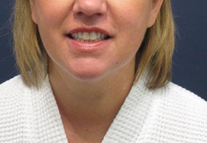 Neck Liposuction Before & After