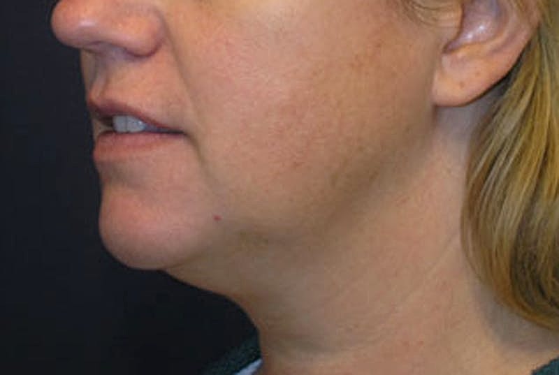 Neck Liposuction Before & After