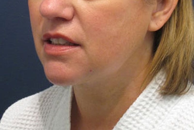 Neck Liposuction Before & After