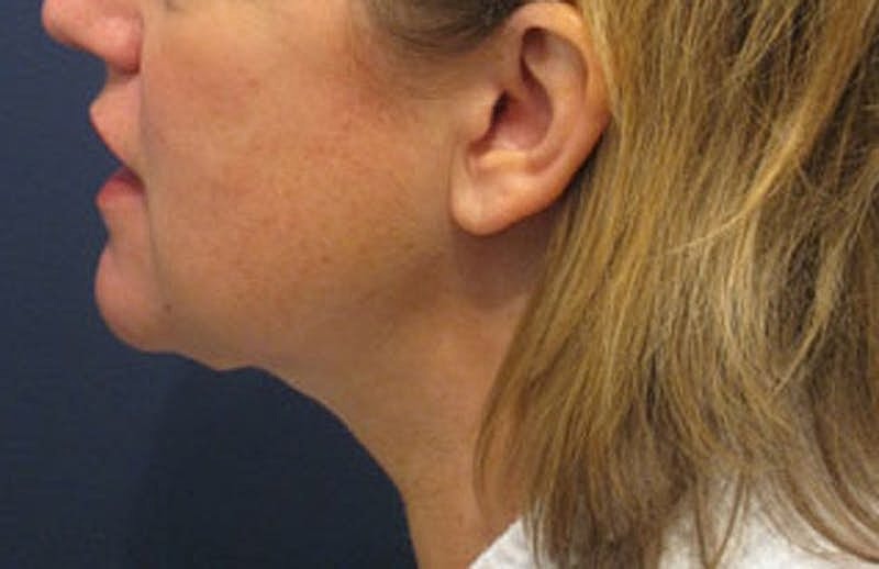 Neck Liposuction Before & After