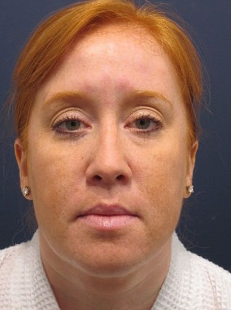 Neck Liposuction Before & After