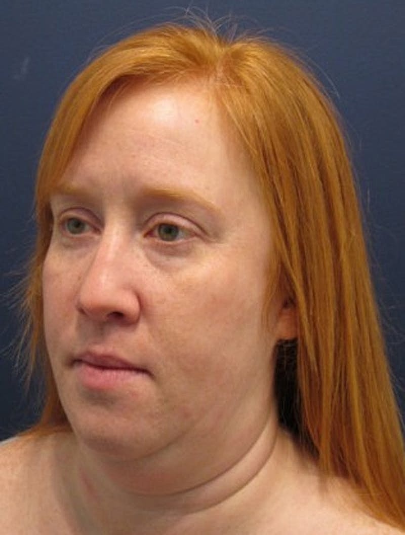 Neck Liposuction Before & After