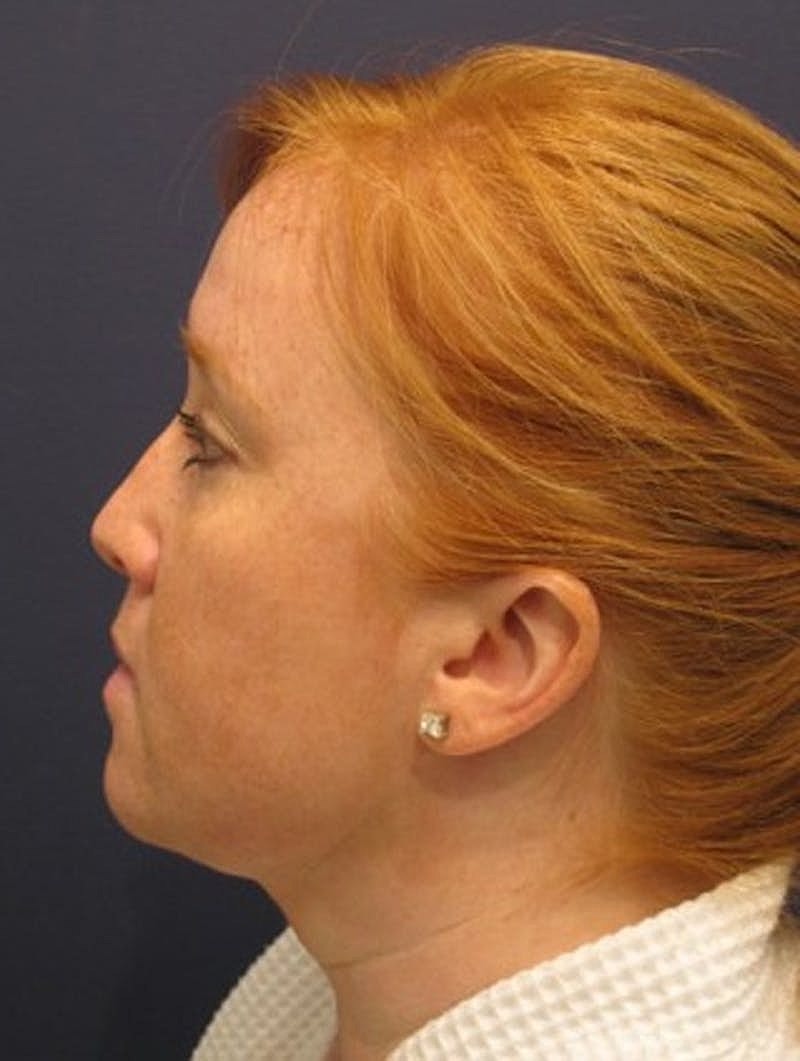 Neck Liposuction Before & After