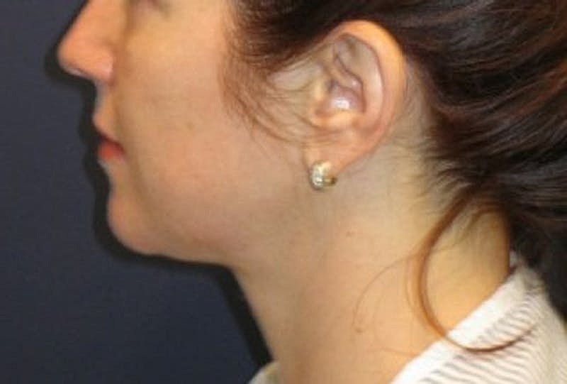 Neck Liposuction Before & After