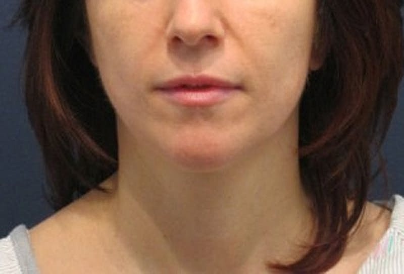 Neck Liposuction Before & After