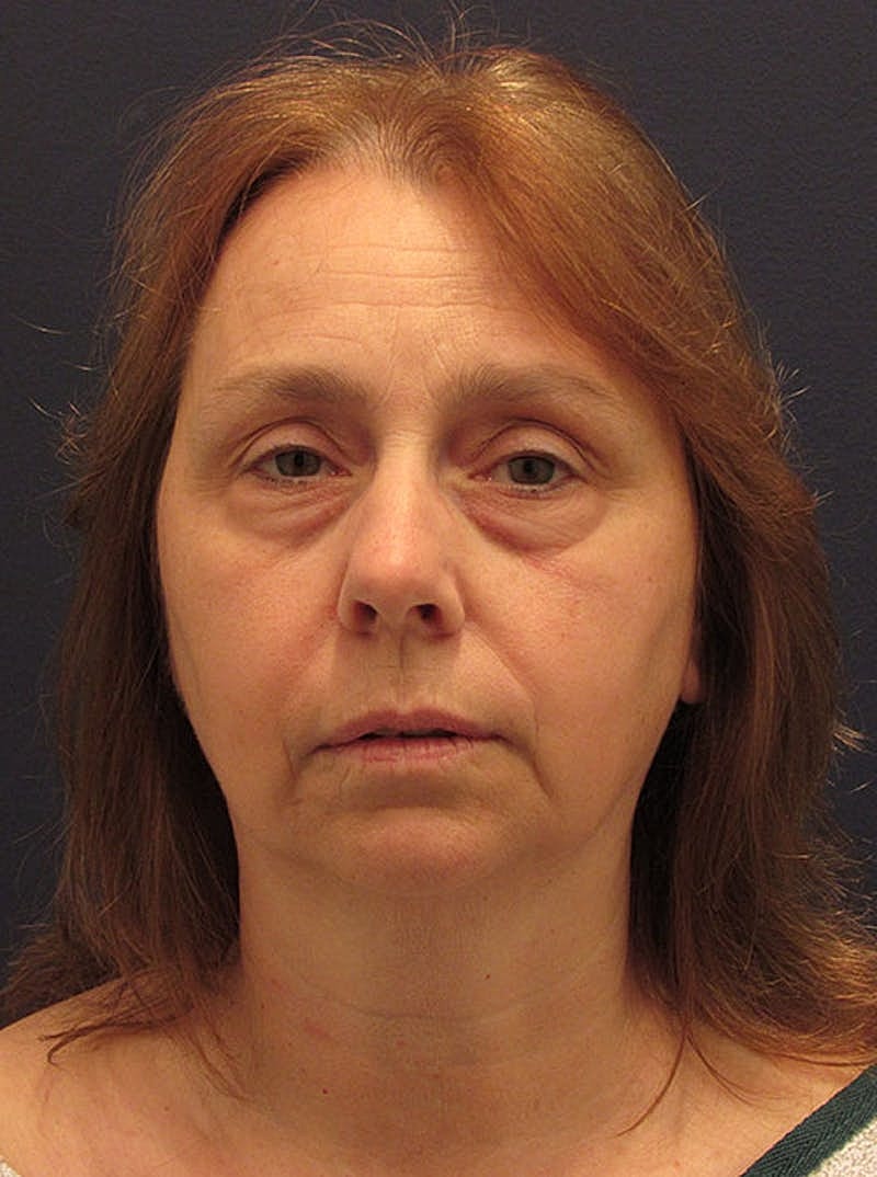 Neck Liposuction Before & After