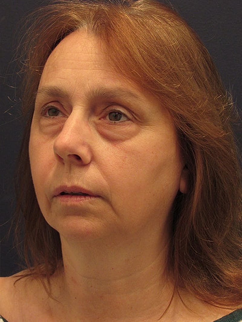 Neck Liposuction Before & After