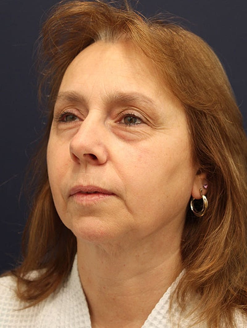 Neck Liposuction Before & After