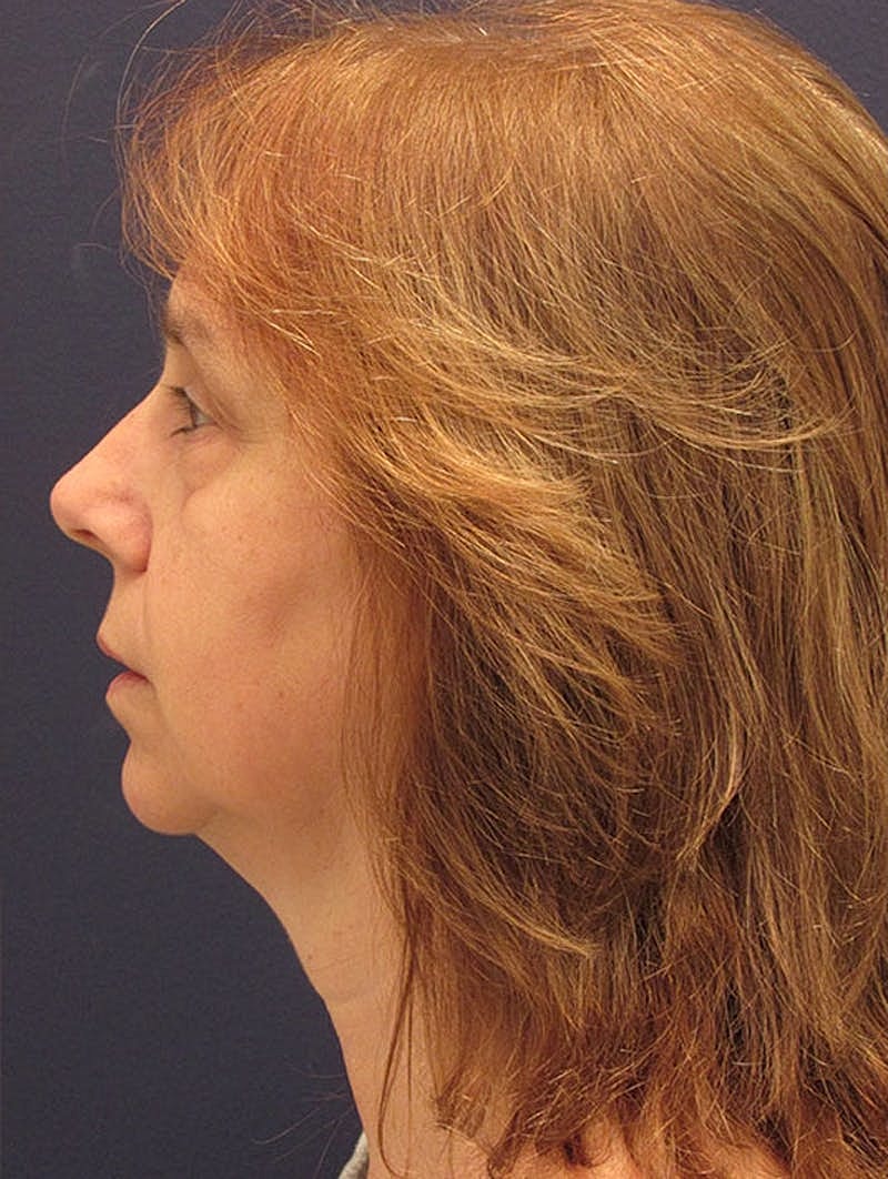 Neck Liposuction Before & After