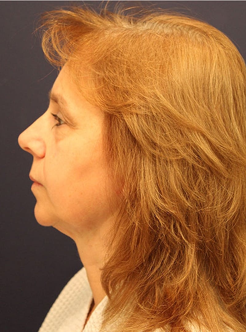 Neck Liposuction Before & After
