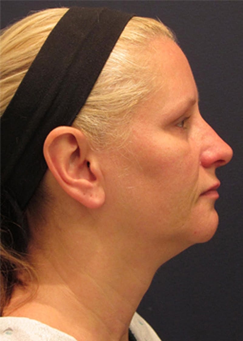 Neck Liposuction Before & After