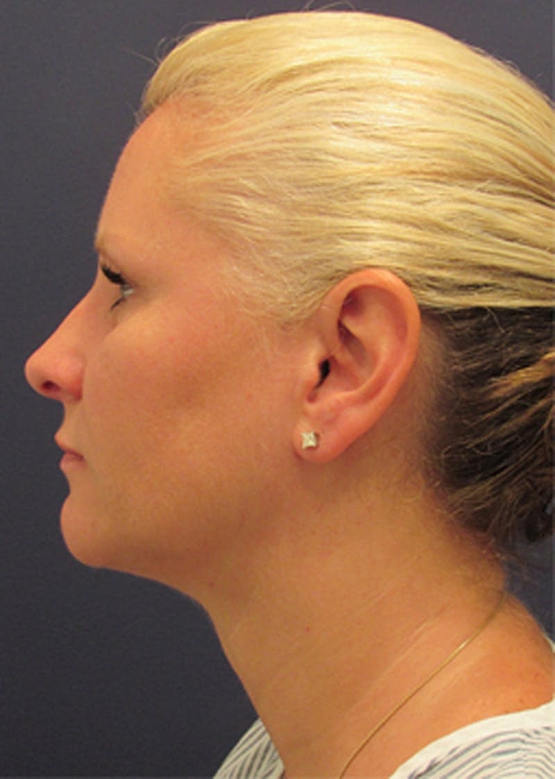 Neck Liposuction Before & After
