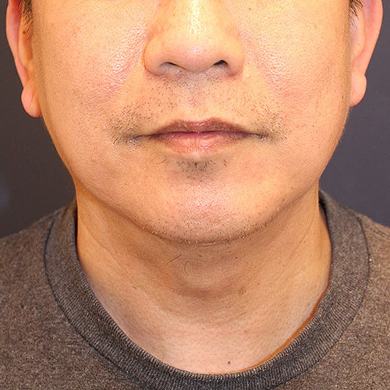 Neck Liposuction Before & After