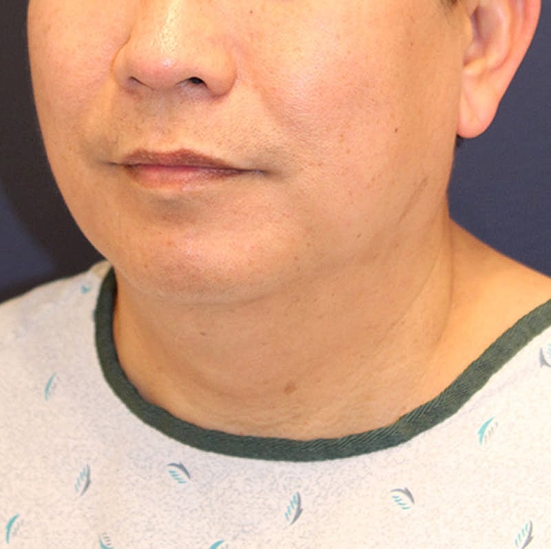 Neck Liposuction Before & After