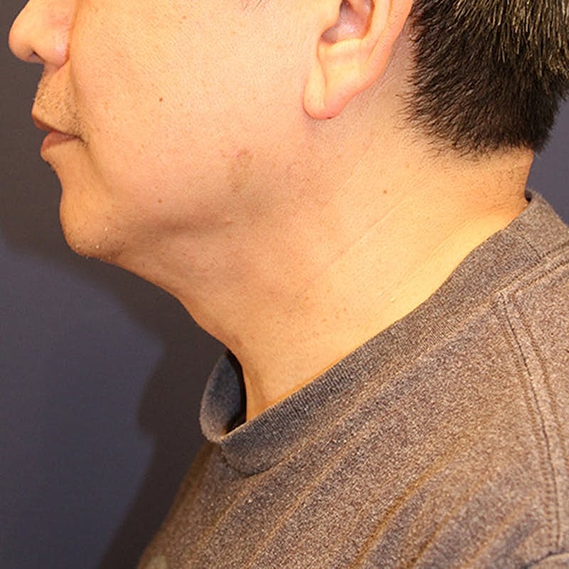 Neck Liposuction Before & After