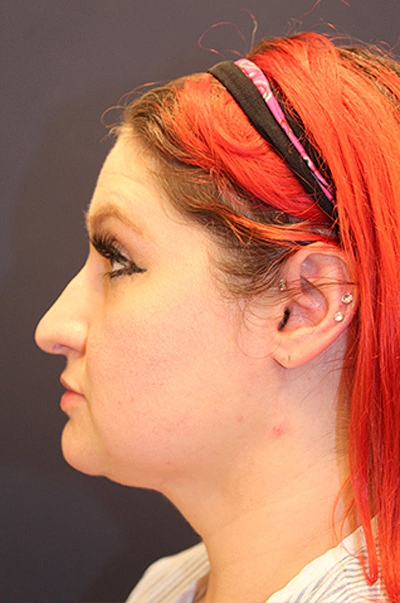 Neck Liposuction Before & After