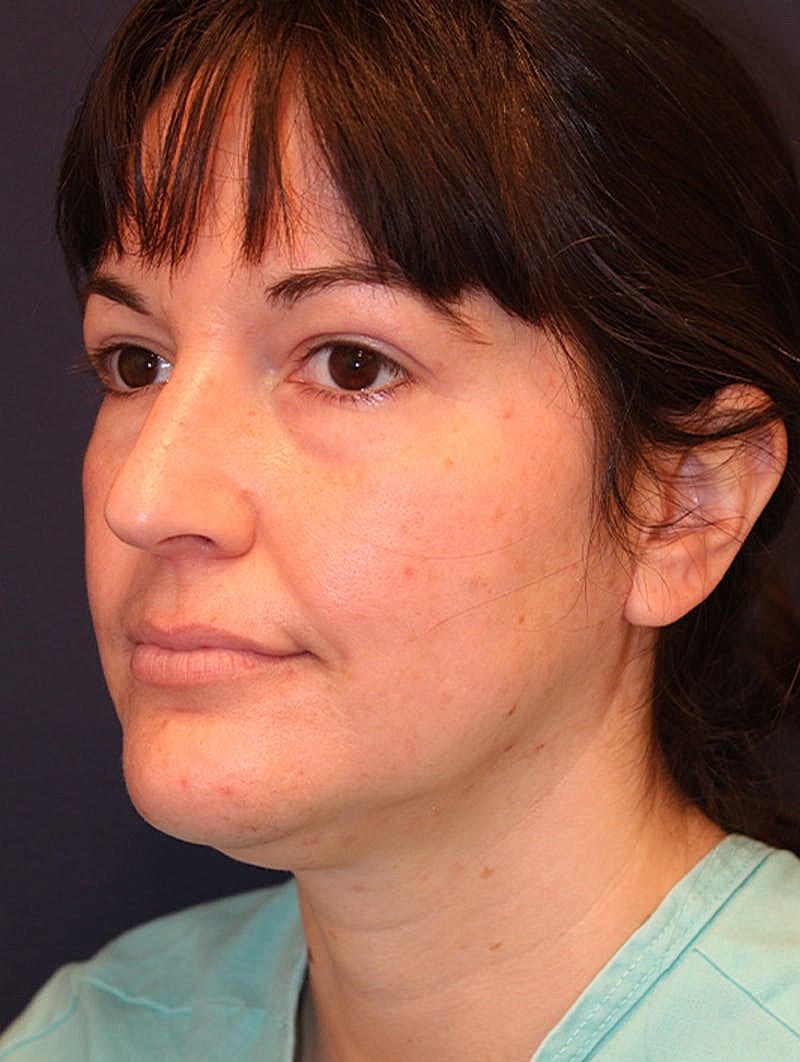 Neck Liposuction Before & After