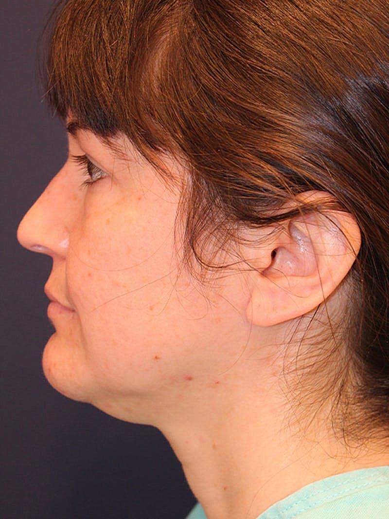 Neck Liposuction Before & After