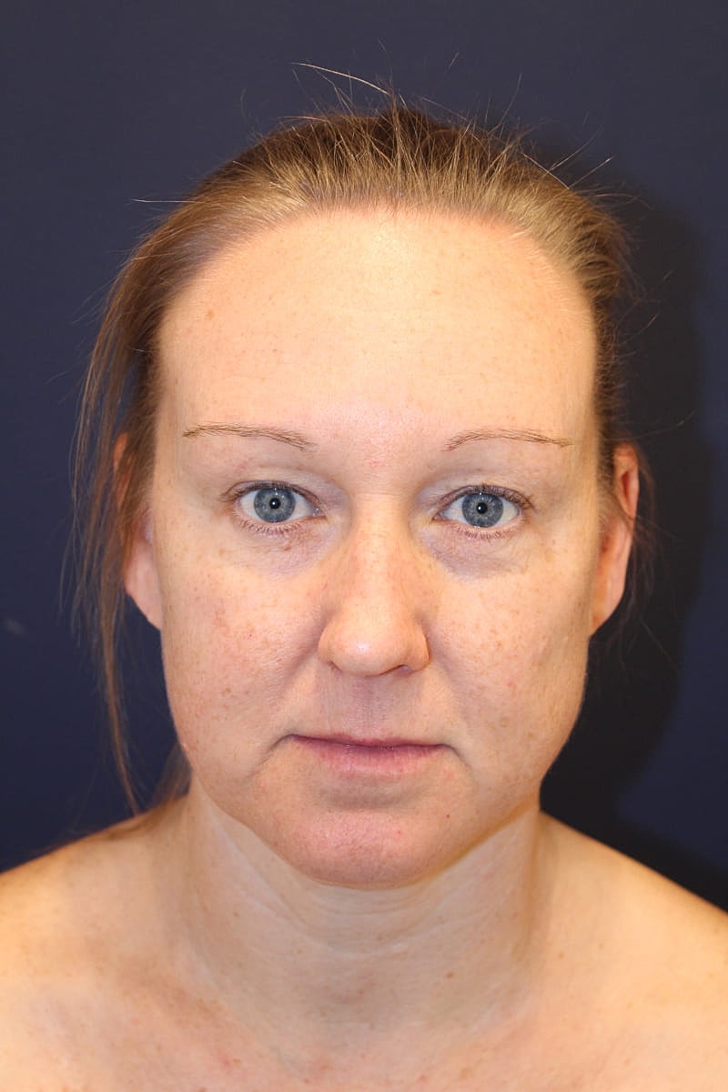 Neck Liposuction Gallery Before & After