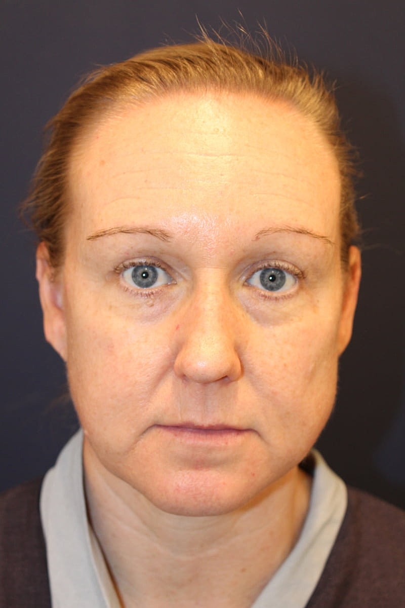 Neck Liposuction Gallery Before & After